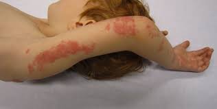 Zona zoster (herpes zoster) este o infectie virala ce afecteaza radacinile nervoase. Zona Zoster Herpes Zoster Cauze Simptome Si Tratament
