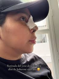 recuperandomedeapoquito💞 #paratii #fyp #rinoplastia