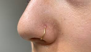 Recurring White Pustule On Nose Piercing Halp Piercing