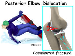 Image result for Elbow Dislocation