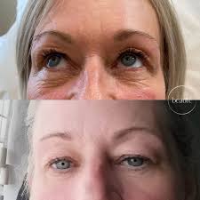 🌟Amazing treatment available atWilson Aesthetics🌟 💬DM for consultation  and bookings