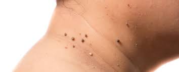Y para responderte de una manera concisa. Que Significa Para Tu Salud Tener Verrugas En El Cuello