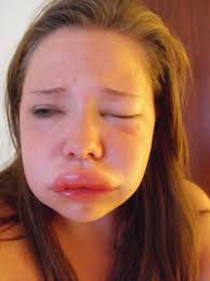 Young woman lives in danger of choking to death as her face swells to  DOUBLE its size