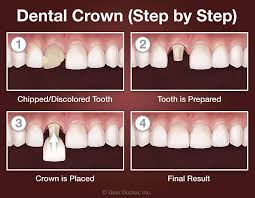 Ceramic, gold and glass ionomer tooth fillings. Dental Crowns Dentist Beaufort Sc Ladys Island Dental Care