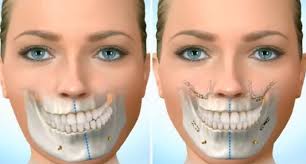 Cirurgia Ortognática