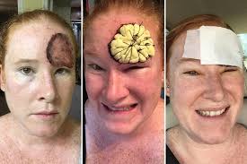 Find out how to spot the early signs of skin cancer. Brave Mum Posts Graphic Daily Photos Of Her Face As She Battles Skin Cancer Which Ate Away At Her Forehead