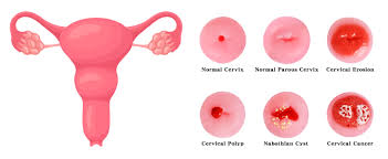 Image result for Friable Cervix