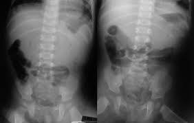 Image result for Intussusception