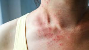 10 Things Itchy Skin Says About Your Health Dermatitis Herpetiformis Skin Diseases Relieve Itchy Skin