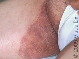 Image result for sore skin in the groin area