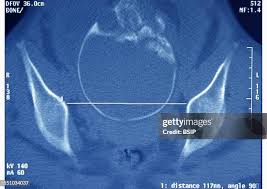 Image result for Pelvimetry