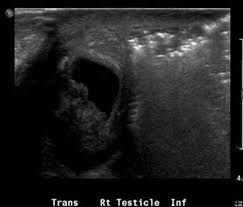 Joint trust clinical procedure for the management of haematuria v1.1 Fournier S Gangrene Ultrasound Radiology Emergency
