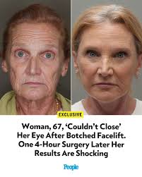🔗: bit.ly/4duLxqe When Allison got plastic surgery years ago, things  didn't go as planned. 📷: Dr. Oren Tepper