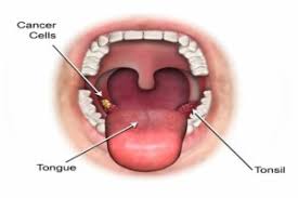 Mouth and throat cancers may look like open sores, growths, or discolored areas in the mouth. Oral Cancer Screening Posts And Articles From Lowcountry Family Dentistry