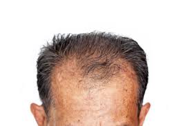But the good news is that many causes of sudden, significant hair loss can be very. Chicago Rapid Weight Loss Or Hair Loss Lawyers Pintas Mullins Law Firm