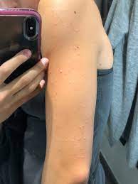 While you cant really get rid of it, i personally exfoliate the backs of my arms (along with the rest of my body), using exfoliating gloves, followed up with microdermabrasion is an option for an area such as the backside of the arms. Small Bumps On Backs And Sides Of Arms P Beauty Insider Community