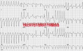 Image result for Ventricular Fibrillation Management in the Adult