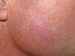 But too much fun without protecting your skin from harmful uv rays from the sun can, unfortunately, lead to the development of basal cell carcinoma — the most common, but least dangerous of th. Basal Cell Carcinoma Dermnet Nz