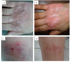 Image result for Anthralin