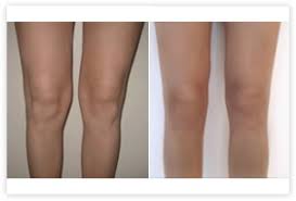 Le but de cette opération est de remplacer par une. Photos Avant Apres Liposuccion Ventre Genoux Cuisses Bras Dr Picovski