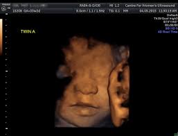 Sydney Ultrasound Centre For Women S Ultrasound