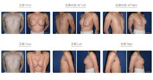 Résultat de recherche d'images pour "breast implant before and after"