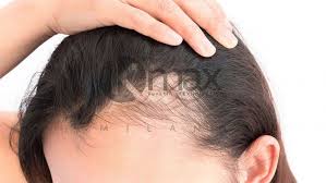 Check out the best yoga asanas to regrow your hair permanently. How The Stress Can Accelerate The Hair Loss Our Tips To Limit It Your Instant Hair Makeup Hair Fiber Kmax
