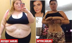 Gastric bypass surgery is the best solution for permanent weight loss. 22 Year Old Shares Revealing Images Showing Excess Skin After Massive Weight Loss Daily Mail Online