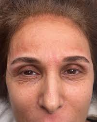 נטף לוי-מיקרובליידינג גבות שפתיים‎