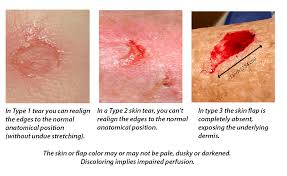 Image result for Skin Tear