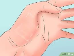 Von glatten untergründen lässt sich alte farbe unter umständen mit dem spachtel entfernen. Steri Strips Entfernen 9 Schritte Mit Bildern Wikihow