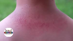 Image result for sweat rash on back