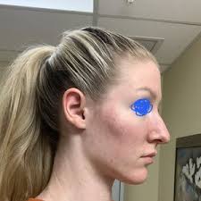 What can I do about my narrow/small jaw? (Photo)