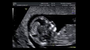 A nuchal scan or nuchal translucency (nt) scan / procedure is a sonographic prenatal screening scan (ultrasound) to detect chromosomal abnormalities in a fetus, though altered extracellular matrix composition and limited lymphatic drainage can also be detected. Nuchal Translucency Scan 11 Weeks 14 Weeks Youtube