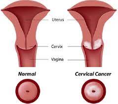 Maybe you would like to learn more about one of these? Kanker Serviks Ciri Ciri Penyebab Dan Pencegahan Kanker Serviks Bidanku Com