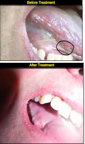 You can identify the presence of mouth cancer by examining your mouth and the surrounding areas for certain signs and symptoms. Newly Diagnosed Six Step Screening