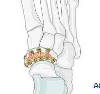 ORIF - Navicular plate for Complete articular navicular fracture