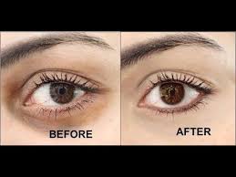 How To Remove Eye Dark Circles Dark Circles Dark Circles Treatment Dark Circles Makeup