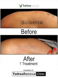In other words, the shallowest layers of ink are removed before the deepest layers. Tattoo Vanish Removal Method