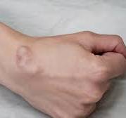 Ganglion Cysts: Symptoms, Causes, and Treatment