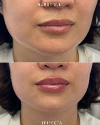 Maximize Your Botox Results: Expert Tips for Longer-Lasting Effects