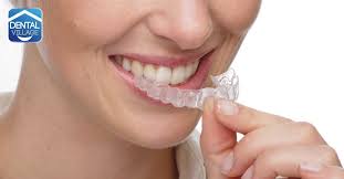 051 6232040vediamo insieme come si inseriscono le mascherine trasparenti nelle due arcate, e se sono davvero cos. Invisalign Provoca Dolore Ai Denti Dental Village