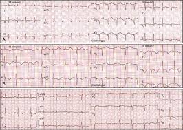Miocardite ou cardiopatia inflamatória é a inflamação do músculo cardíaco. Miocardiopatia De Takotsubo Num Servico De Cardiologia Sciencedirect