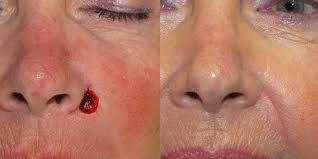 The cancers should be removed. Island Flap Skin Cancer And Reconstructive Surgery Center