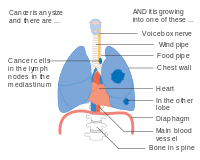 The earliest stage of nsclc is stage 0 (also called carcinoma in situ, or cis). Lung Cancer Wikipedia