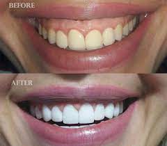 Pin By Suzy Bear On Plastic Smile Makeover Dentist Dental