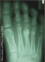 Now though, it pains me all the time and it seems to be regressing with pain and bruising. Keys To Managing Common Pediatric Foot Fractures Podiatry Today