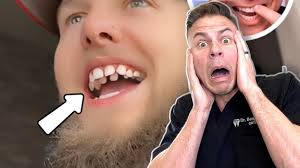 This Is The Secret To Getting The Whitest Teeth Ever! 😬🦷 #teeth #veneers  #holiday #nye