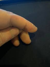 How do you say dyshidroses? Dyshidrotic Eczema Reddit Post And Comment Search Socialgrep