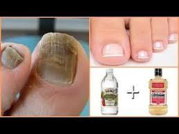 Hongos En Las Uñas De Las Manos Como Eliminarlos Elimina Los Hongos De Las Unas De Los Pies Con Este Remedio Youtube En 2020 Cura Hongos En Las Unas Remedios Hongos Unas Eliminar Hongos De Las Unas